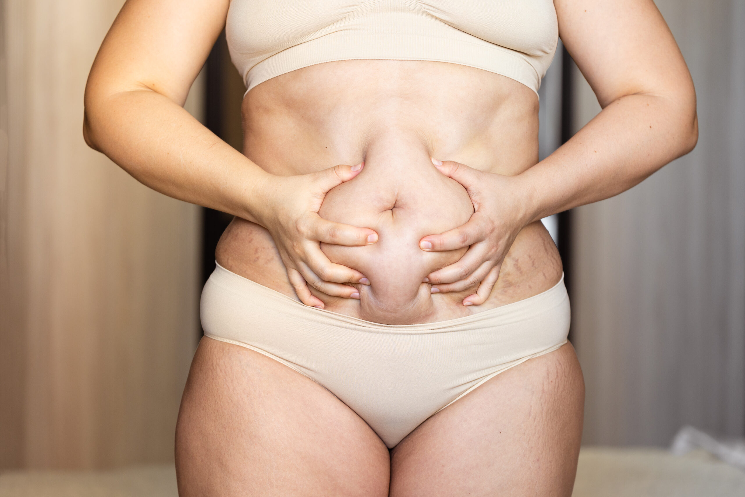 Cropped of overweight fat woman holding tummy excess flabs in underwear. Fast weight loss, showing cellulite. Obesity stomach, diastasis disease. Emphasizing excess adiposity, spare adiposity