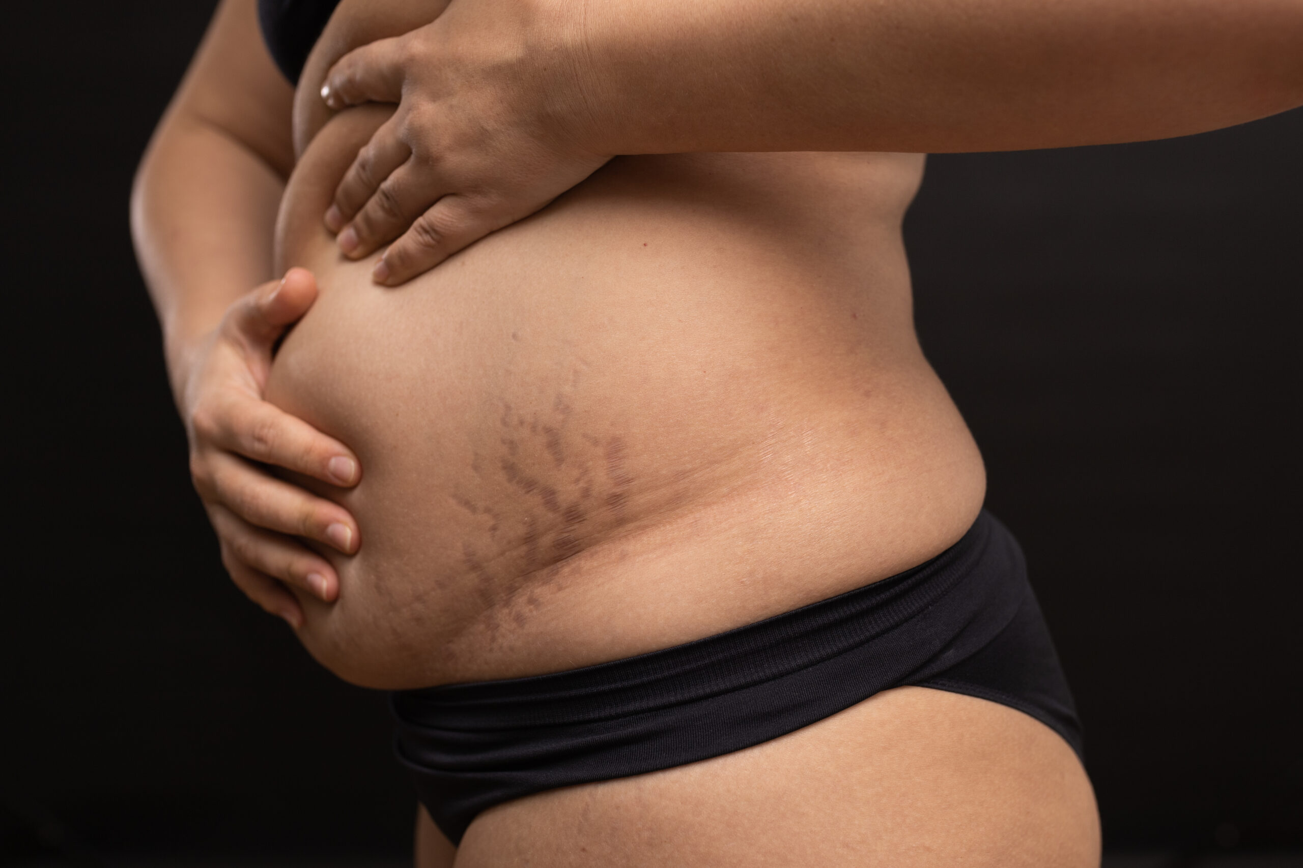 Female hanging belly with stretch marks on skin closeup. Overweight woman flaunt figure imperfections. Studio portrait isolated on black. Plus size people. Concept of body positive, self acceptance.